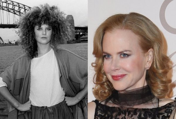 Nicole-Kidman-Frozen-Botox-Face-Cheek-Injections