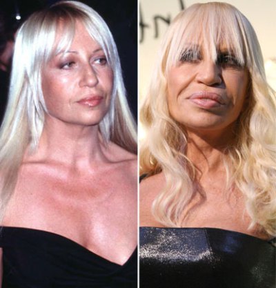 donatella-versace-plastic-surgery-by-50